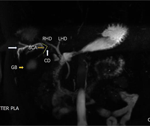 MRCP image of case 1 and the region of interests used to obtain measurement. White arrow shows dilated bile duct in S5. The arrow labeled as GB shows atrophied gallbladder; the CD joins in the RHD directly, so the SCA can be calculated as the angle between the CD and RHD, just as the arrow labeled as SCA shows.
