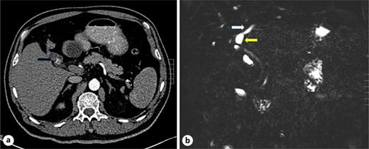 CT and MRCP images of case 2. a shows the atrophied gallbladder within it the accumulation of sediment-like stones (black arrow) in CT of arterial phase. b shows the atrophied gallbladder (yellow arrow) constitutes part of the dilated RHD (white arrow) in MRCP image of the right posterior position.