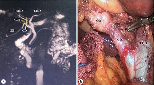 Region of interests used to obtain measurement in MRCP image and intraoperative anatomy of case 3. a shows the CD joins in the RHD, which converges with the LHD to form choledoc duct, so the common bile duct is absent and the SCA can be calculated as the angle between CD and RHD (yellow arrow). b The anatomic variation of extrahepatic bile duct in operation. LHD, left hepatic duct.