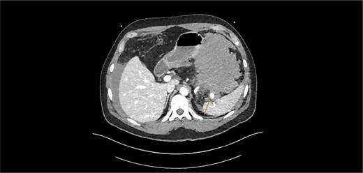 CT scan axial: hyperdense mass (56 HU) attached to the greater curvature of the stomach. Arrow pointing to partially thrombosed aneurysm of the splenic artery.