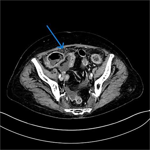 CT scan that shows infiltration of intra-abdominal fat with suspicion of carcinomatosis.