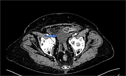 CT scan that shows ascites mainly in area around of the urinary bladder.