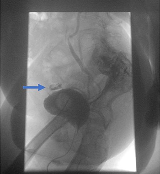 Result of cystography: bladder of smaller capacity approx. 120 mL, leak in the vertex area outside the bladder lumen, thin fistula.