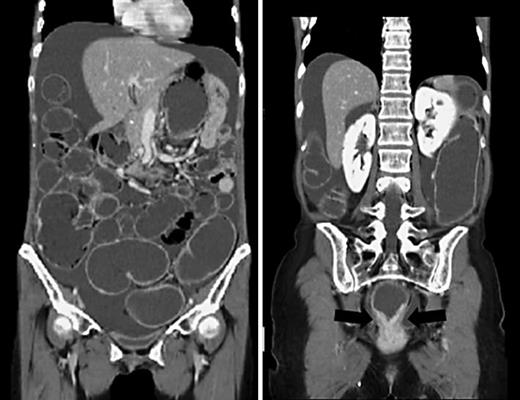 Fig. 1. Coronal images of abdominal CT. Ileal and colonic dilation with fluid is seen. A medium amount of ascites is evident.