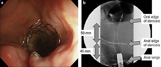 Fig. 2. a Endoscopic image of the rectum with stenosis and the inserted stent. The stent was inserted into the rectal stenosis from the anal side. The distal end of the expanded endoprosthesis is seen. b The stenosis is 5 cm long, and the WallFlex colonic stent (6 cm in length, 22 mm in diameter) was placed in the rectum. The anal side edge of the stent is 2 cm from the oral side of the anal verge.