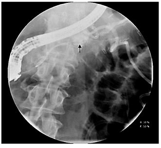 Fig. 1. Pancreatogram demonstrating a pancreatic fistula after distal pancreatectomy (arrow).
