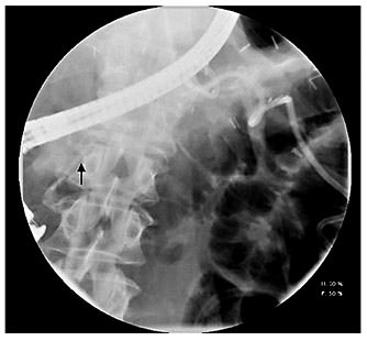Fig. 2. Pancreatogram demonstrating pancreatic duct stent placement (arrow).