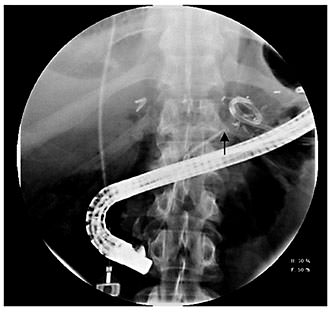 Fig. 3. Pancreatogram demonstrating resolution of the pancreatic fistula (arrow).