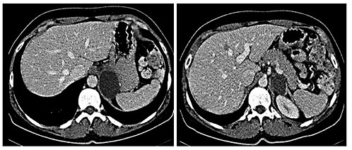 Fig. 1. Axial abdominal CT showing the dense cystic mass in the left suprarenal region adjacent to the pancreas.