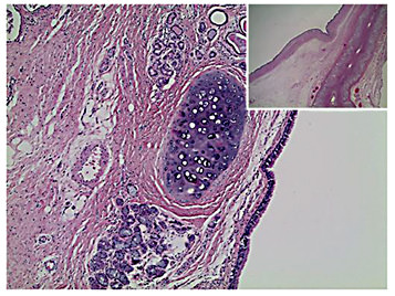 Fig. 2. Microscopic view of the bronchogenic cyst (HE, ×40, ×10). The cyst had a smooth inner lining and contained a grey viscous mass. Microscopically, it consisted of ciliated, respiratory epithelium, seromucous glands and fully developed cartilage, without any malignant or dysplastic cells.