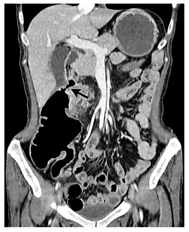 Fig. 1. Abdominal CT scan showing the colo-duodenal fistula on coronal view (arrow).