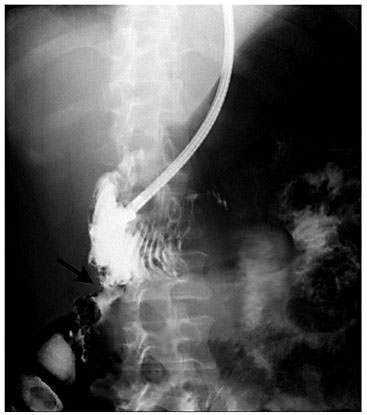 Fig. 2. Contrast radiography demonstrated flow through the colo-duodenal fistula (arrow).