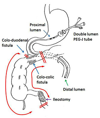 Fig. 3. Schema showing the gastro-jejunostomy tube, the location of two fistulae and the procedure performed at the second operation (right hemi-colectomy).