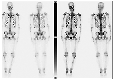 Fig. 3. Bone scan revealing multiple areas of increased uptake of technetium-99 (Tc-99m-hydroxymethane diphosphonate) in the bilateral proximal humeri, distal humeri, left proximal forearm, bilateral ribs, bilateral tibias, and bilateral metatarsals.