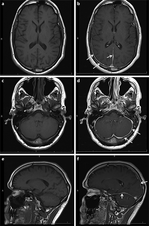 A Case of Hypertrophic Pachymeningitis Associated with Immunoglobulin