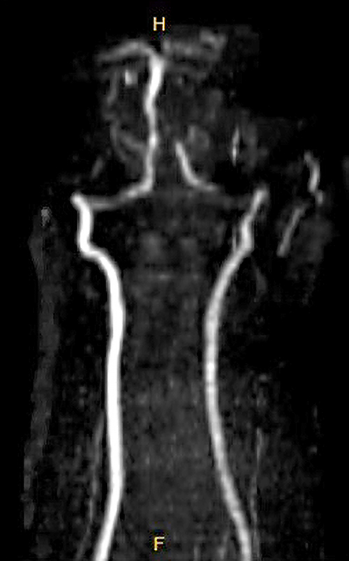 Sequential Bilateral Vertebral Artery Dissections with Prompt