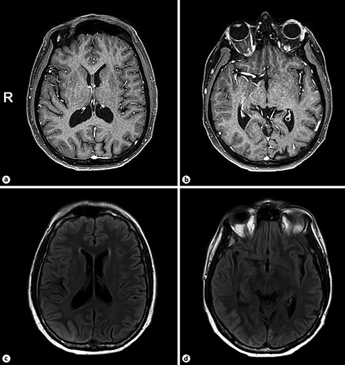 SMART Syndrome Identification and Successful Treatment Case Reports