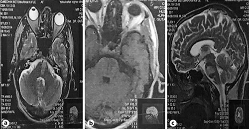 Fig. 1. a Axial T2 brain MRI showing a wedge-shaped segmental hyperintense lesion in the left paramedian pons. b Axial T1 brain MRI showing a wedge-shaped segmental hypointense lesion in the left paramedian pontine region. c Sagittal T2 brain MRI showing a wedge-shaped segmental hyperintense lesion extending from the basis pontis to the tegmentum pontis, indicating subacute infarction.