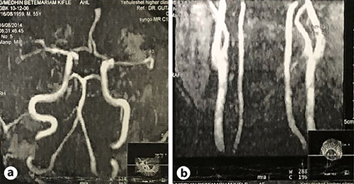 Fig. 2. a Both the common carotid artery and the internal and external carotid arteries were normal and patent, and the circle of Willis and its major branches were well demonstrated. b Both vertebral arteries were well visualized and normal.