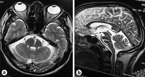 Fig. 3. a Axial T2 brain MRI showing a segmental hyperintense lesion in the left paramedian pons. b Sagittal T2 brain MRI showing a segmental hyperintense lesion extending from the ventral to the dorsal pons, indicating chronic paramedian pontine perforator infarction.