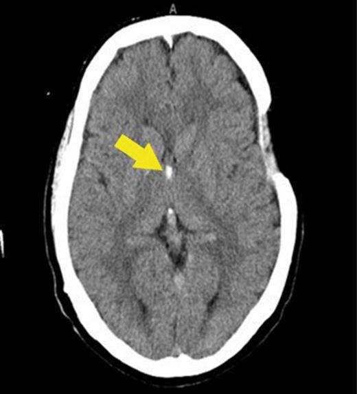 OvershuntingRelated Cervical Myelopathy Causing Progressive Gait