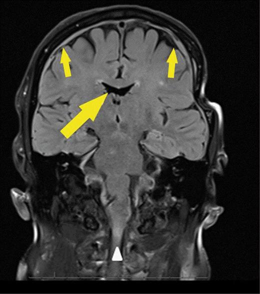 OvershuntingRelated Cervical Myelopathy Causing Progressive Gait
