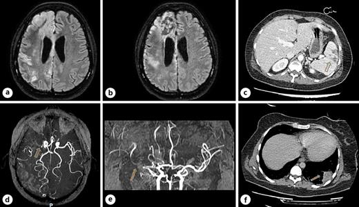 case study of stroke Fig. 1. Imaging. a April 16, 2020; MRI of the brain: lesions in the right hemisphere affecting the territories of the anterior and the middle cerebral arteries. b May 5, 2020; MRI of the brain: same lesions in the right hemisphere shown in the previous image. d, e May 5, 2020; MRA showed an early duplication of the sphenoidal segment of the right middle cerebral artery, the branches of which are irregular with rosary bead-like aspect and reduction of blood flow in the middle cerebral artery. c April 20, 2020; CT of the abdomen: vascular lesion, consistent with a splenic infarct, found in the inferior pole of the spleen. f April 20, 2020; CT of the chest: basal subpleural area of increased density within the left lung (4 × 4 × 3 cm), consistent with a pulmonary infarction. MRA, magnetic resonance angiography; CT, computed tomography; MRI, magnetic resonance imaging.