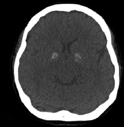 Unusual Presentation of Cerebral Lupus A Case Report of Parkinsonism
