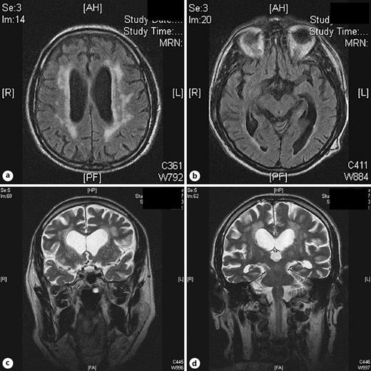 Belly Dancer’s Dyskinesia 3 Cases of a Rare Entity Case Reports in