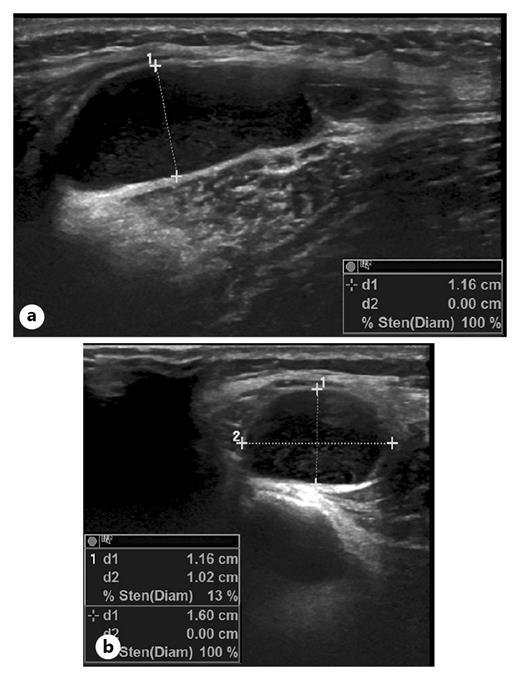 Large Intraneural Ganglion Cyst in the Peroneal Nerve Case Reports in