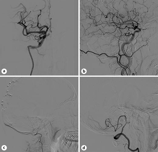 Posterior Circulation Mechanical Thrombectomy through Primitive