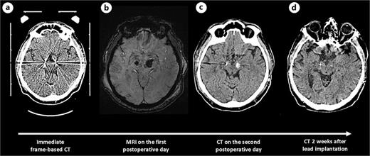 Timeline of occurrence of ICH: an immediate frame-based CT obtained after lead implantation confirmed accurate lead placement, minimal pneumocephalus, and the absence of hemorrhage (a); on the first postoperative day, the patient exhibited no neurological deficits and demonstrated a micro-lesion effect of STN DBS, though MRI, including axial SWI sequences at the midbrain level, revealed a hemorrhage around the left lead (axial plane, SWI sequence) (b); on the second postoperative day, due to clinical worsening CT scan was obtained showing ICH alongside the left lead, accompanied by minor perifocal edema (c); and control CT 2 weeks postoperatively showing complete regression of the ICH with no perifocal edema or structural damage, while the patient’s hemiparesis improved to a mild condition (d). SWI, susceptibility-weighted imaging.
