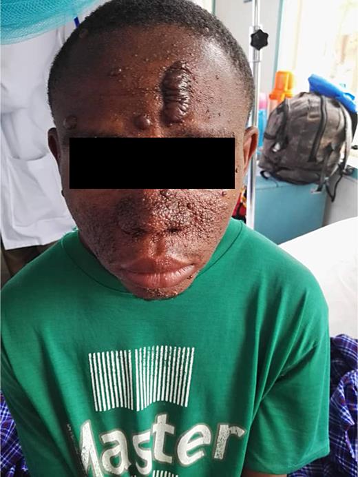 Facial angiofibromas appear as multiple small, raised, reddish-brown to flesh-colored papules distributed predominantly over the cheeks, nose, and nasolabial folds. Additionally, a prominent fibrous plaque is visible on the forehead, characterized by a larger, firm, thickened, and elevated lesion. Fibrous plaques of variable sizes are visible on the forehead and scalp.