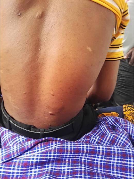 Hypomelanotic macules are visible as faint, lighter-colored patches on the sides of the back. A shagreen patch is present on the lower back, characterized by a slightly raised, thickened, and rough-textured area.