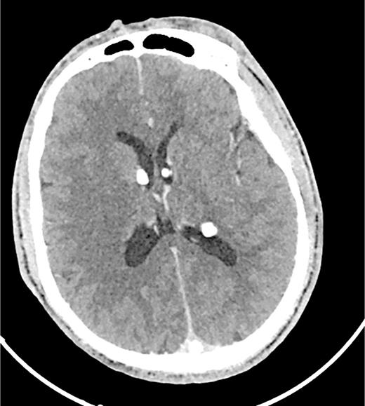 Head CT scan demonstrating multiple calcified SENs lining the lateral ventricles.