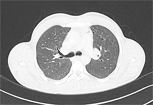 Chest CT scan demonstrates numerous thin-walled, round cystic spaces scattered throughout both lungs, consistent with cystic lung disease.