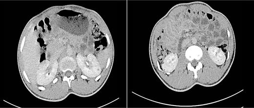 Abdominal CT scans show multiple renal angiomyolipomas (AMLs). The AMLs appear as heterogeneous masses involving both kidneys.