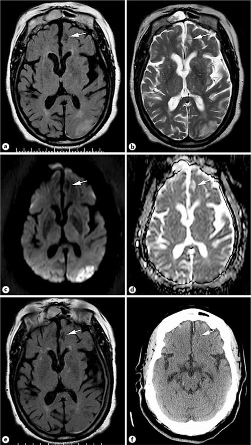 Vocalization in Dementia A Case Report and Review of the Literature