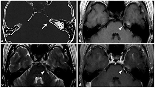 Fig. 1. a Preoperative bone-window CT showing the suprameatal tubercle with hyperostosis on the left side (arrow). b T1-weighted image showing an isointense lesion (arrowhead) covering the bony bulge. c T2-weighted image showing the hyperintense lesion (arrowhead). d Gadolinium-enhanced T1-weighted image showing a well-enhanced lesion (arrowhead) covering the bony bulge.