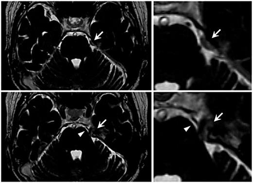 Fig. 2. Preoperative 3D FIESTA MR images showing an extra-axial tumor (arrow) at the entrance of Meckel's cave that medially compressed and distorted the trigeminal nerve root. The SCA (arrowhead) runs medially proximal to the trigeminal nerve.