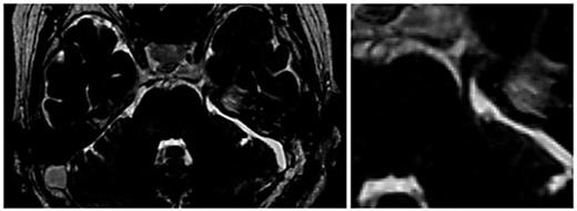 Fig. 3. Postoperative 3D FIESTA MR images showing the gross total removal of the tumor and the decompressed and straightened trigeminal nerve root.