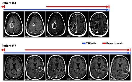 Fig. 1. Radiographic appearance of bevacizumab-refractory GBM treated with TTFields and subsequently rechallenged with bevacizumab. Representative pictures of serial gadolinium contrast-enhanced brain MRI scans of patients No. 4 and No. 7 are shown. Colored bars denote time line of TTFields therapy and bevacizumab rechallenge. The time frame is in months, starting from the first documented radiographic diagnosis of bevacizumab-refractory GBM. Patient No. 4 demonstrated an initial response to TTFields at 2 months but progressed radiographically at 4 months. Upon rechallenge with bevacizumab, this patient's GBM demonstrated a radiographic response to bevacizumab again. Patient No. 7 did not demonstrate radiographic response to TTFields in the first 2 months. However, this patient had a durable radiographic response to bevacizumab rechallenge while continuing on with TTFields therapy.