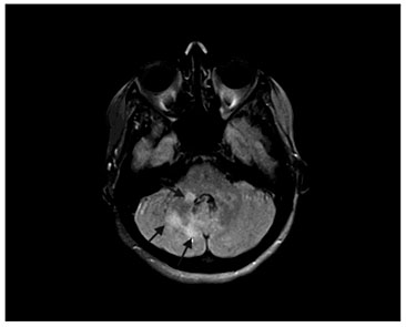 Fig. 1. MRI at the onset of neurological symptoms. Axial T2-weighted fluid-attenuated inversion recovery (FLAIR) shows patchy high-signal intensity PML lesions in the right cerebellar peduncle.