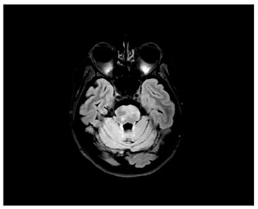 Fig. 2. MRI 5 months later. T2-weighted FLAIR shows a progress of high-signal intensity in the pons.