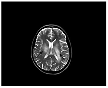 Fig. 3. MRI at the terminal stage of the disease. Axial T2-weighted MRI shows periventricular high-signal intensity.