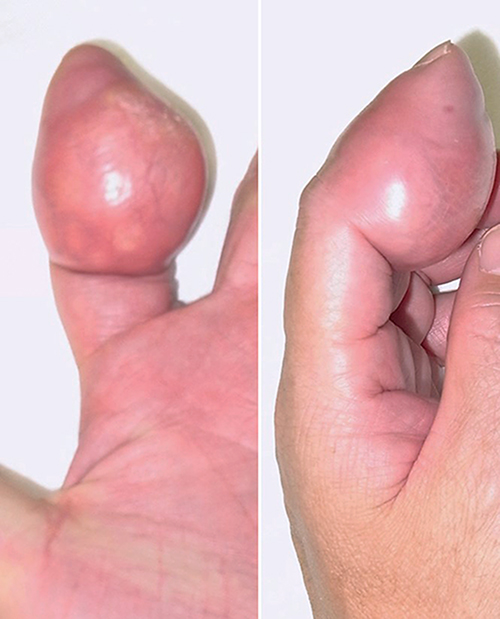 Fig. 1. A mass of about 4 cm in diameter with slight redness in the left index finger.