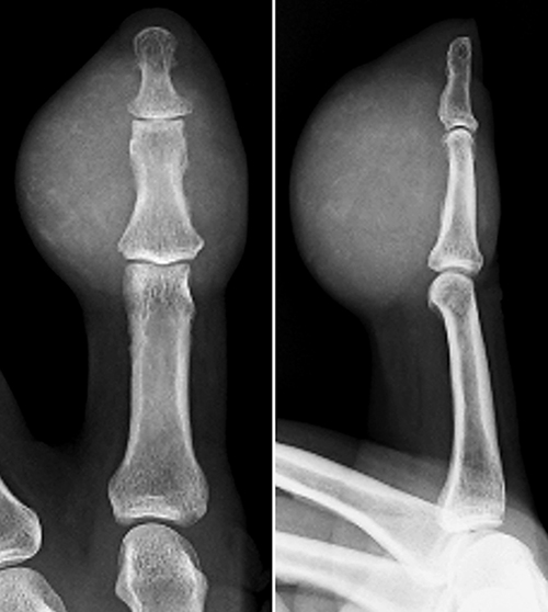 Fig. 2. Plain radiography showing a tumor shadow on the palmar side of the middle phalanx of the left index finger, with faint internal calcification.