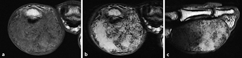 Fig. 3. Magnetic resonance imaging revealing a 40 × 38-mm mass shadow along the flexor tendon. The mass is found to be a well-demarcated tumor, showing uneven isointensity and low-signal intensity on T1-weighted images (a) and uneven high- and low-signal intensity on T2-weighted images (b, c). On both T1- and T2-weighted images, low-signal regions mean calcification in the tumor.