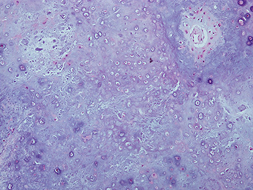 Fig. 4. Histopathological findings showing the presence of mature hyaline cartilage across the tumor mass, with a relatively low cell density and small mononuclear chondrocytes with no apparent atypia.
