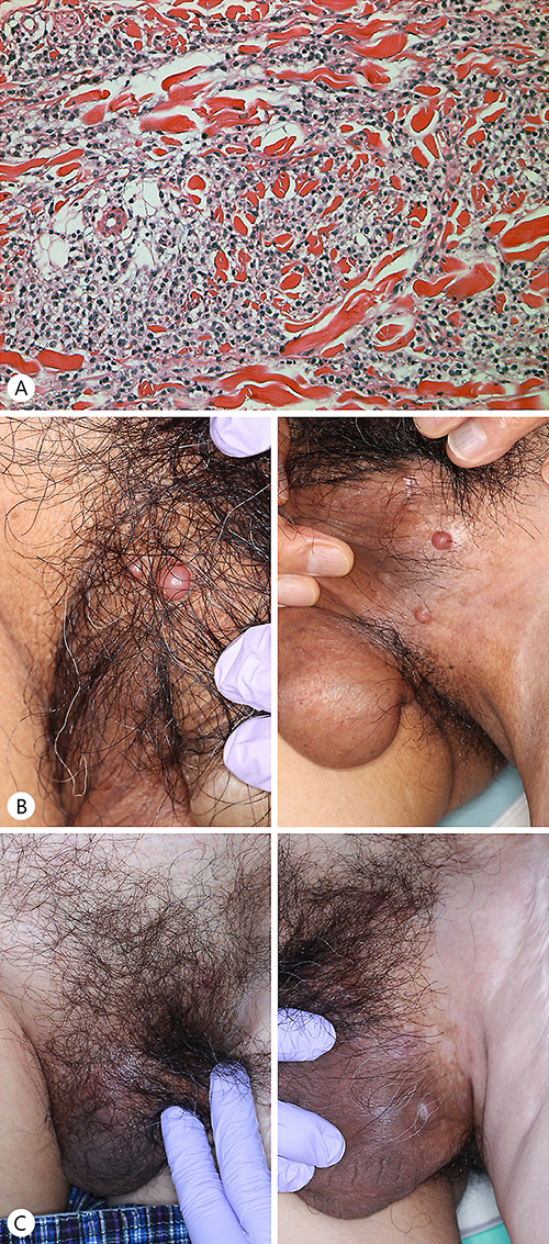 Fig. 1. Dense infiltration of spindle-shaped atypical cells with pigmentation from the superficial dermis to the deep dermis (A). Multiple in-transit metastases on the scrotum that are ingrown: before imiquimod treatment (B) and after imiquimod treatment (C).
